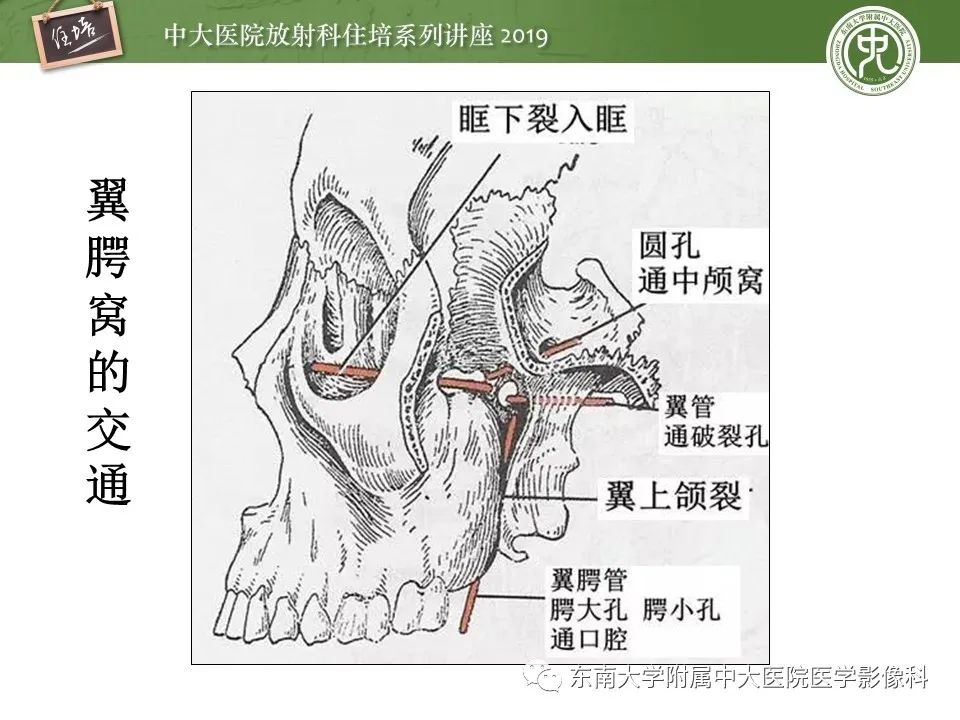 【PPT】翼腭窝的影像解剖及临床意义