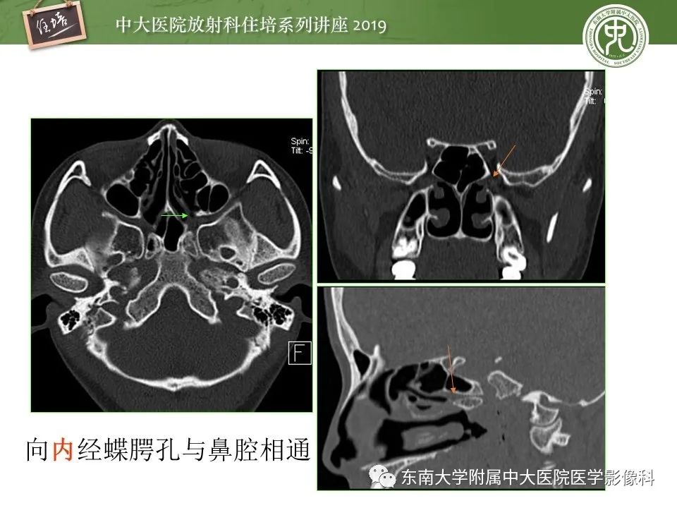 【PPT】翼腭窝的影像解剖及临床意义