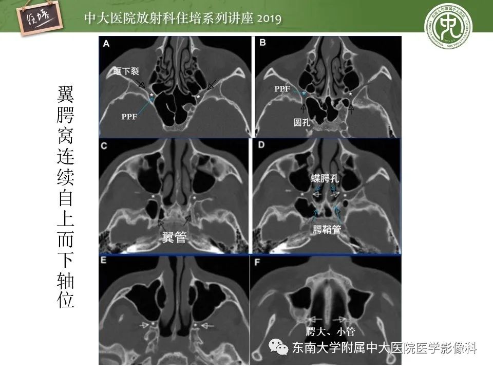 【PPT】翼腭窝的影像解剖及临床意义