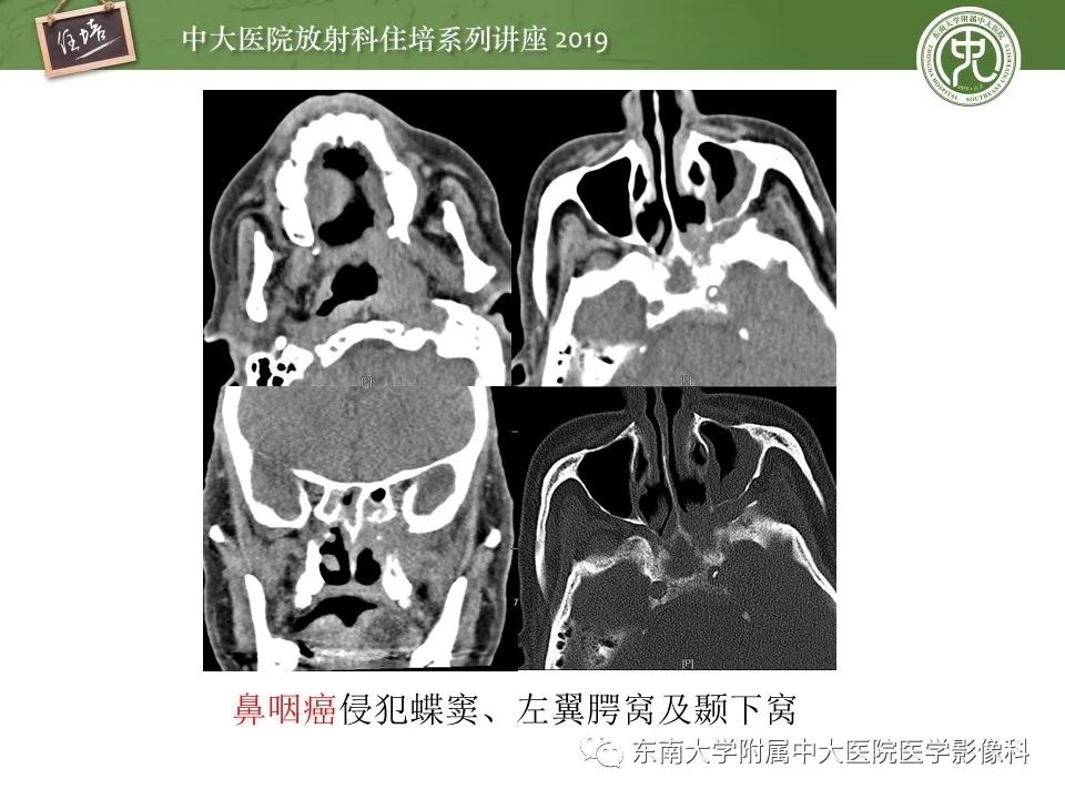 【PPT】翼腭窝的影像解剖及临床意义
