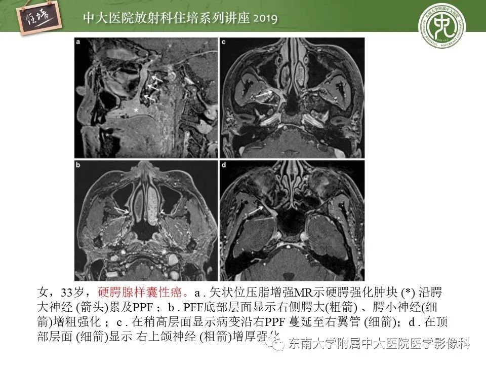 【PPT】翼腭窝的影像解剖及临床意义