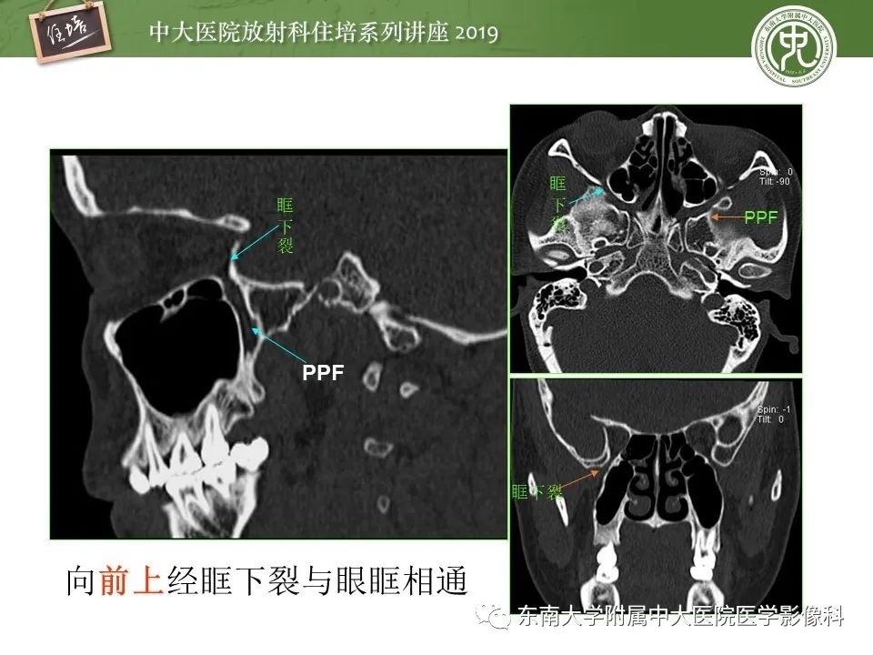 【PPT】翼腭窝的影像解剖及临床意义
