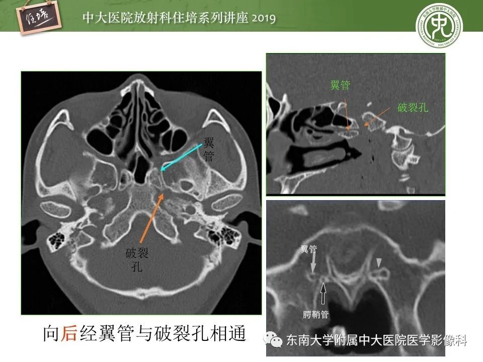 【PPT】翼腭窝的影像解剖及临床意义
