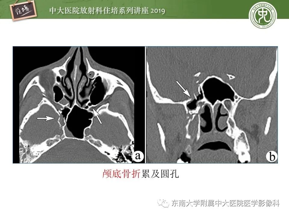 【PPT】翼腭窝的影像解剖及临床意义