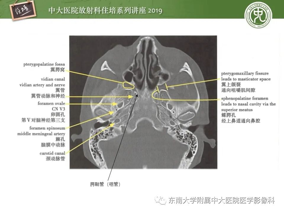【PPT】翼腭窝的影像解剖及临床意义