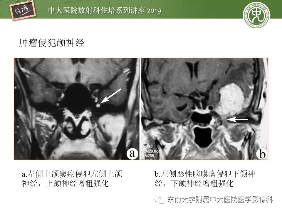 【PPT】翼腭窝的影像解剖及临床意义