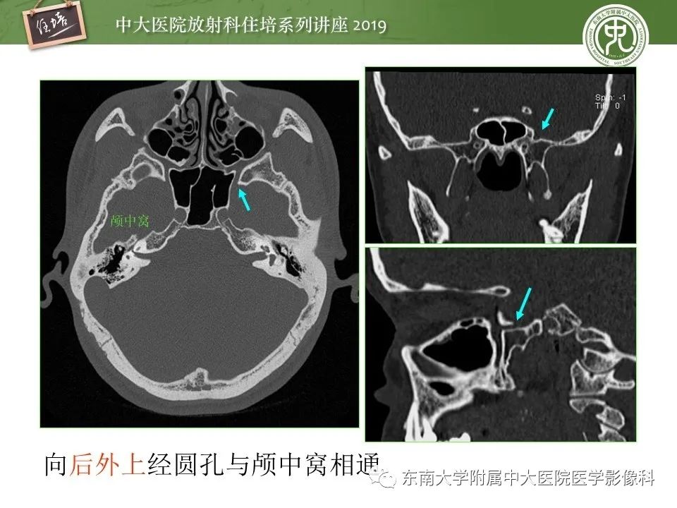 【PPT】翼腭窝的影像解剖及临床意义