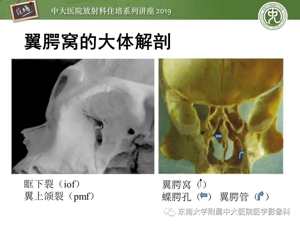 【PPT】翼腭窝的影像解剖及临床意义
