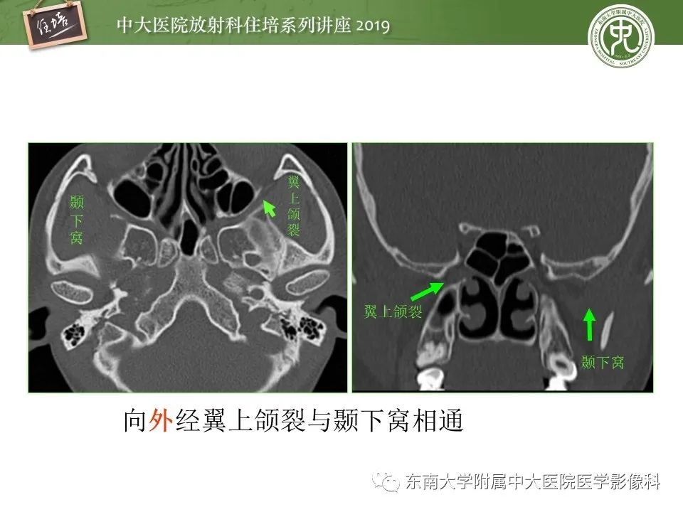 【PPT】翼腭窝的影像解剖及临床意义