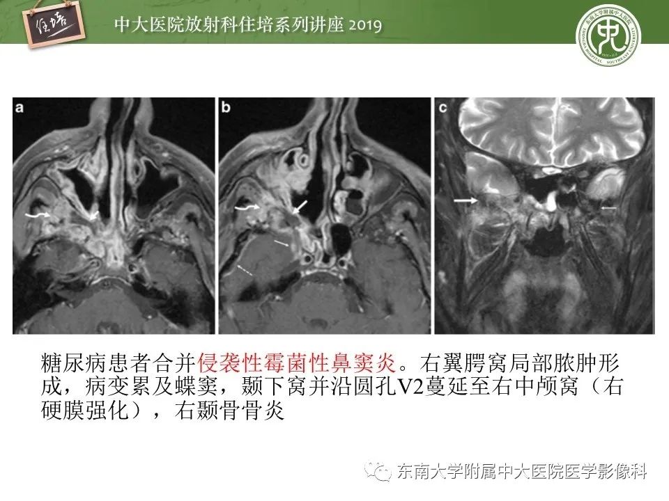 【PPT】翼腭窝的影像解剖及临床意义