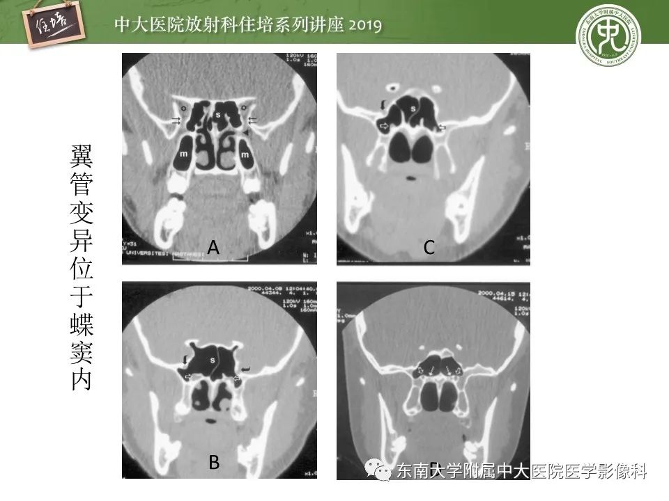 【PPT】翼腭窝的影像解剖及临床意义