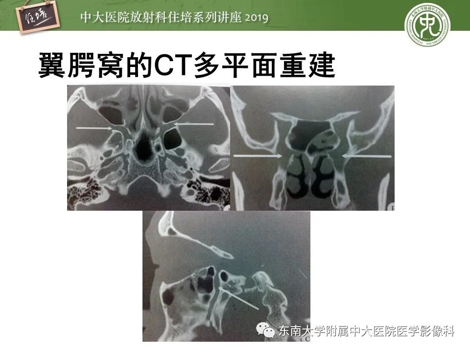 【PPT】翼腭窝的影像解剖及临床意义