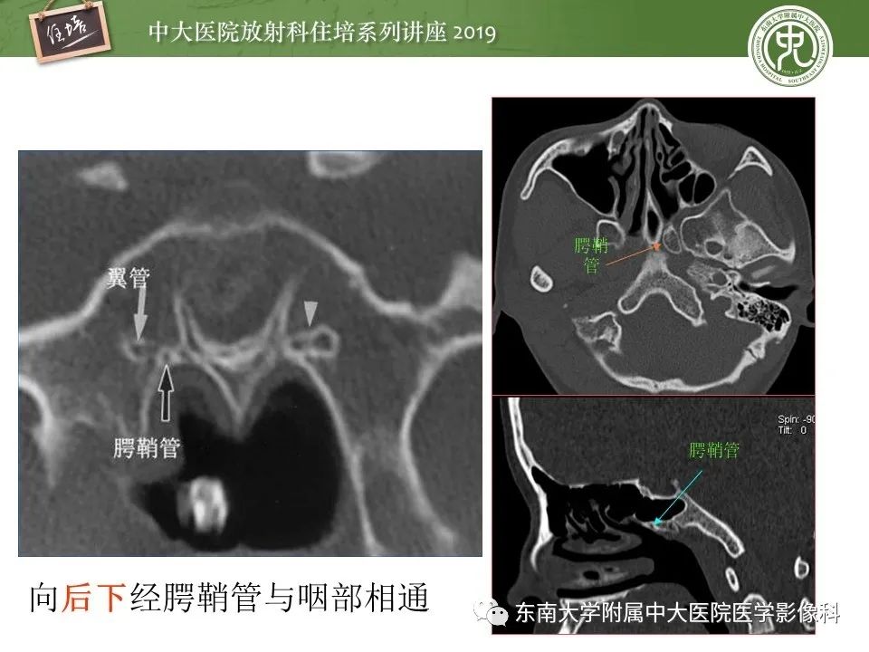 【PPT】翼腭窝的影像解剖及临床意义