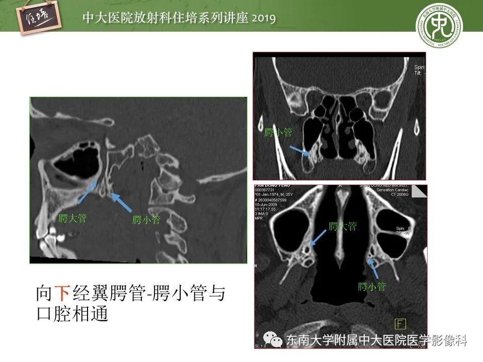 【PPT】翼腭窝的影像解剖及临床意义