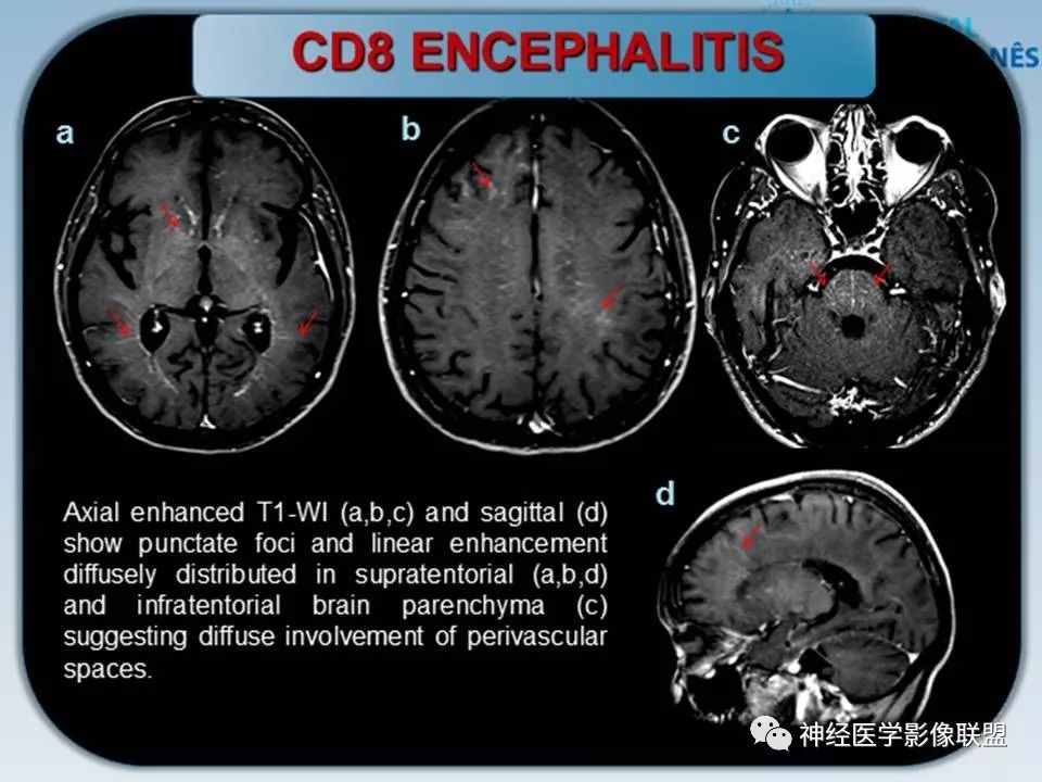【PPT】血管周围间隙模式：血管与脑组织之间病变诊断