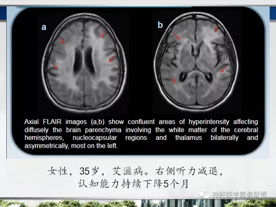 【PPT】血管周围间隙模式：血管与脑组织之间病变诊断