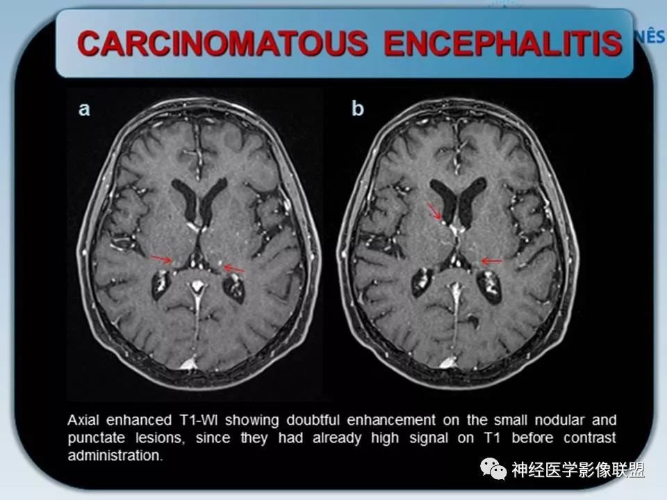 【PPT】血管周围间隙模式：血管与脑组织之间病变诊断