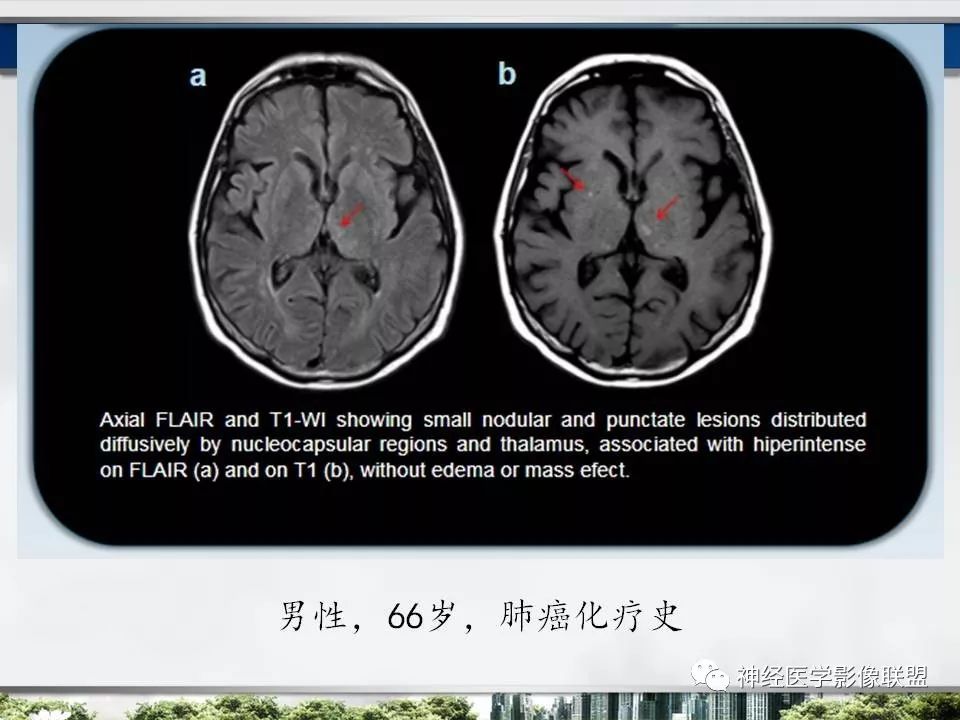 【PPT】血管周围间隙模式：血管与脑组织之间病变诊断