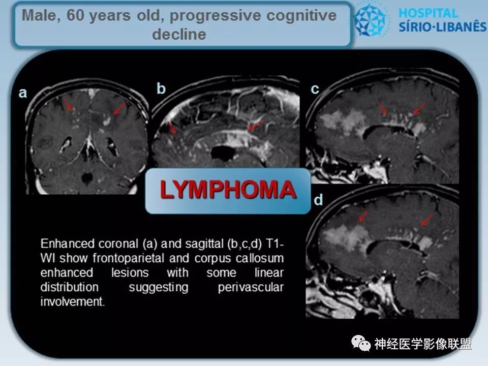 【PPT】血管周围间隙模式：血管与脑组织之间病变诊断