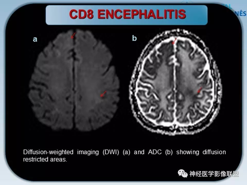 【PPT】血管周围间隙模式：血管与脑组织之间病变诊断