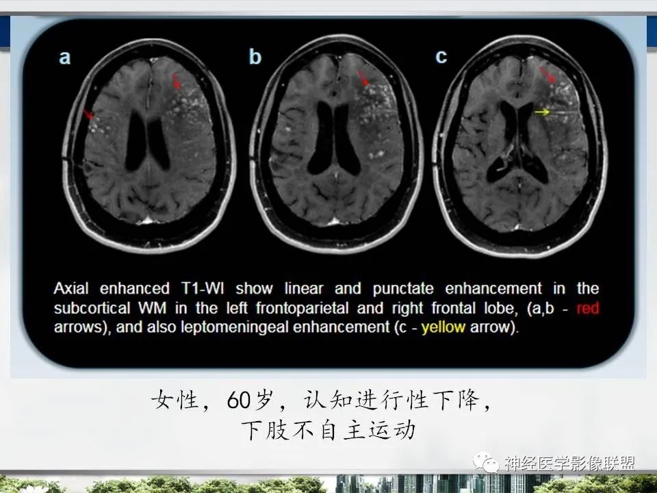【PPT】血管周围间隙模式：血管与脑组织之间病变诊断