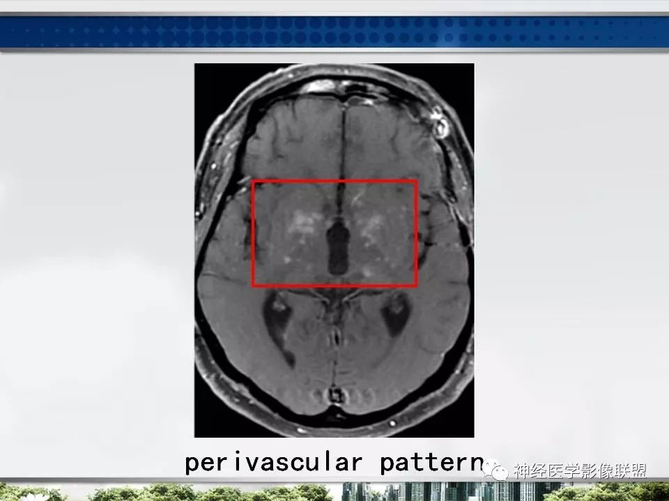 【PPT】血管周围间隙模式：血管与脑组织之间病变诊断
