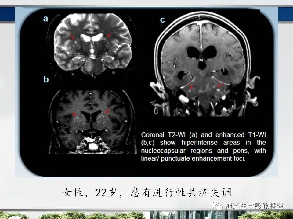 【PPT】血管周围间隙模式：血管与脑组织之间病变诊断