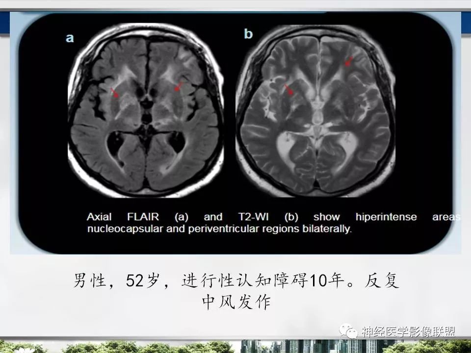 【PPT】血管周围间隙模式：血管与脑组织之间病变诊断