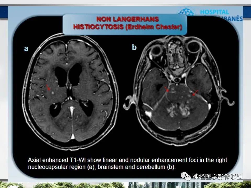 【PPT】血管周围间隙模式：血管与脑组织之间病变诊断