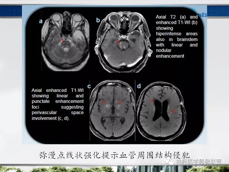 【PPT】血管周围间隙模式：血管与脑组织之间病变诊断