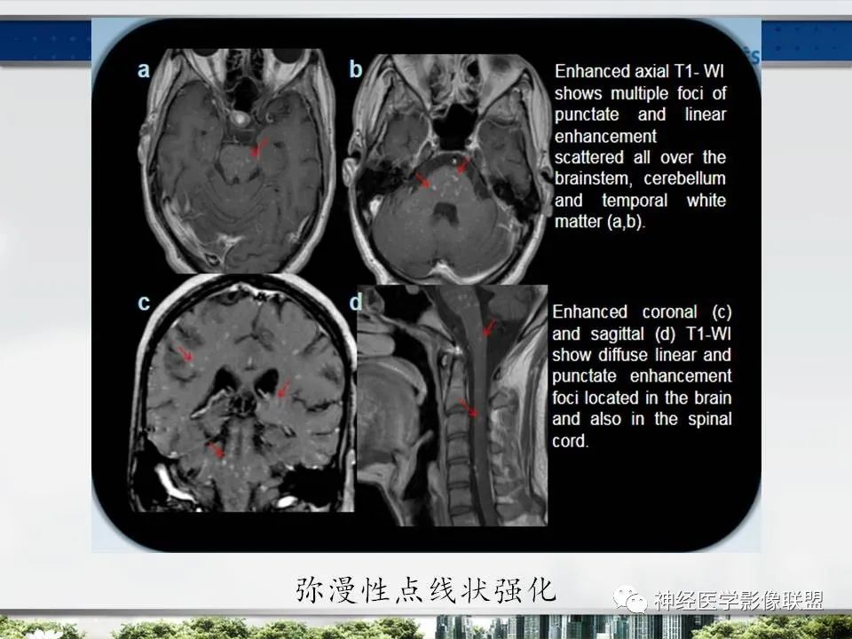【PPT】血管周围间隙模式：血管与脑组织之间病变诊断