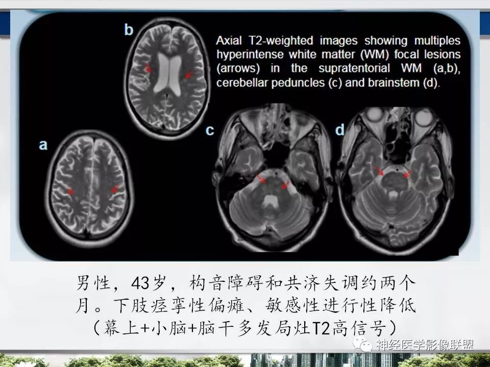 【PPT】血管周围间隙模式：血管与脑组织之间病变诊断