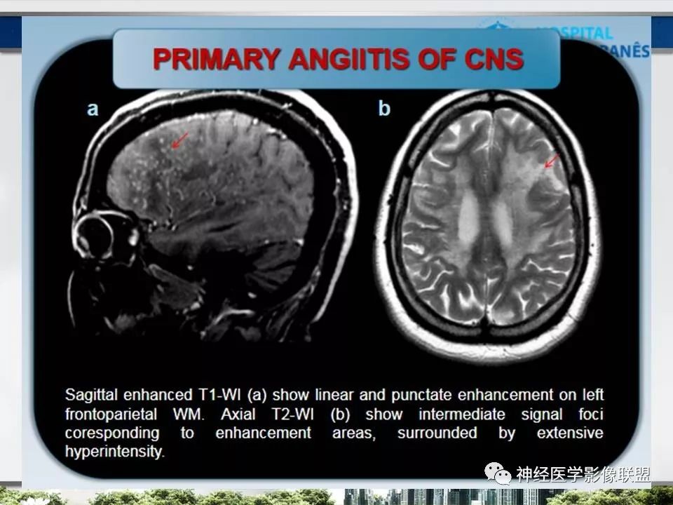 【PPT】血管周围间隙模式：血管与脑组织之间病变诊断