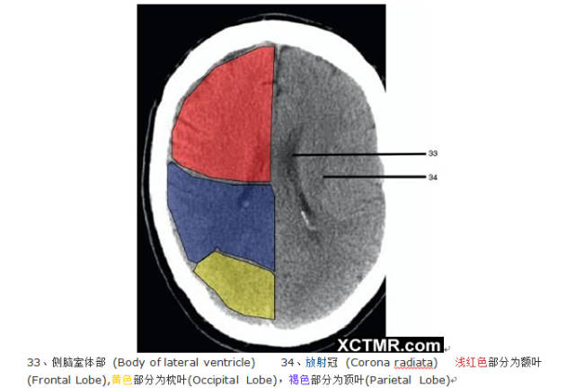 颅脑CT彩色解剖