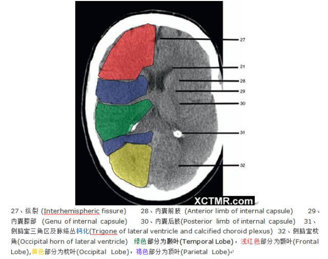 颅脑CT彩色解剖