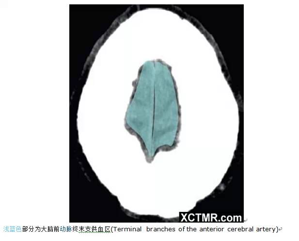 颅脑CT彩色解剖