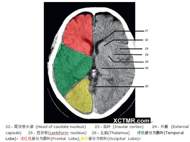 颅脑CT彩色解剖