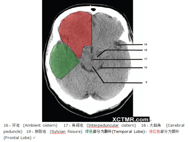 颅脑CT彩色解剖