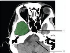 颅脑CT彩色解剖