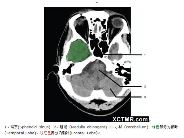颅脑CT彩色解剖