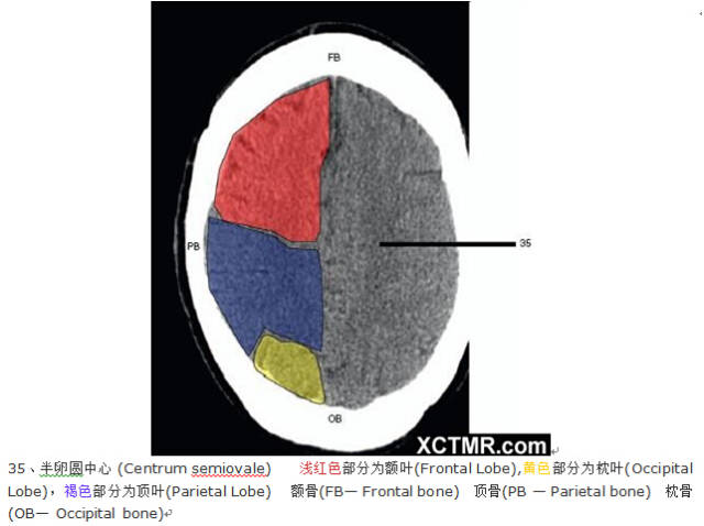颅脑CT彩色解剖