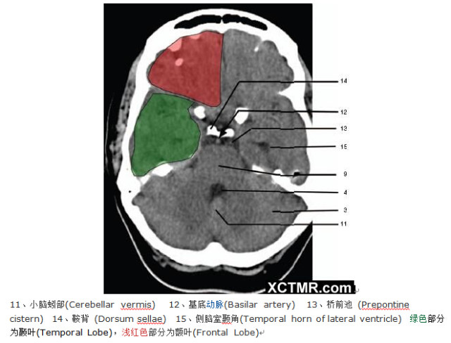 颅脑CT彩色解剖
