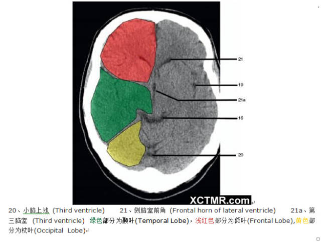 颅脑CT彩色解剖