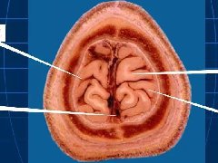 颅脑大体及磁共振断层解剖