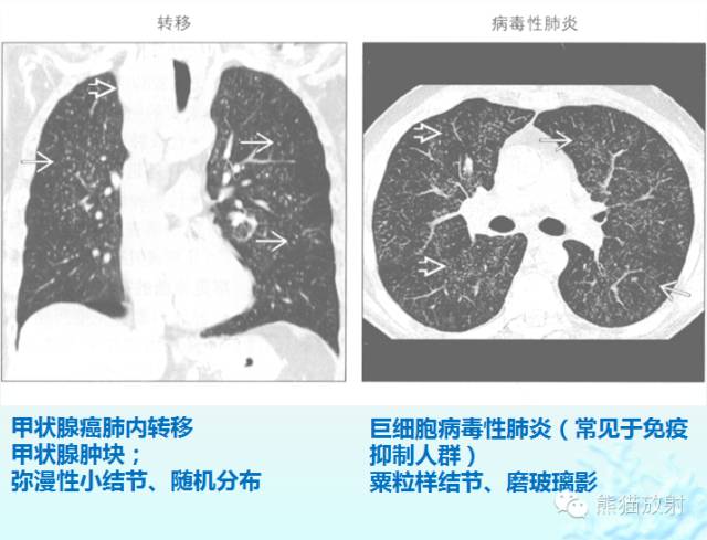 肺粟粒样结节鉴别诊断