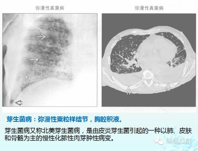 肺粟粒样结节鉴别诊断