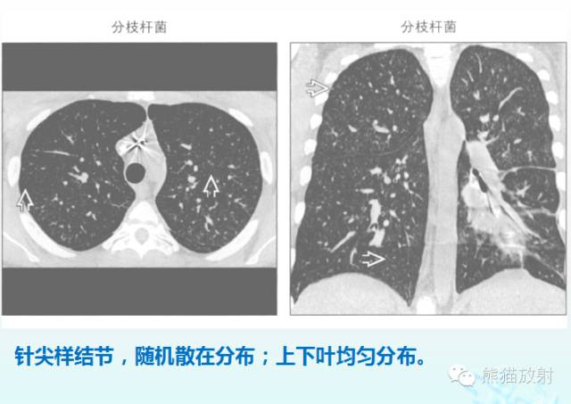 肺粟粒样结节鉴别诊断