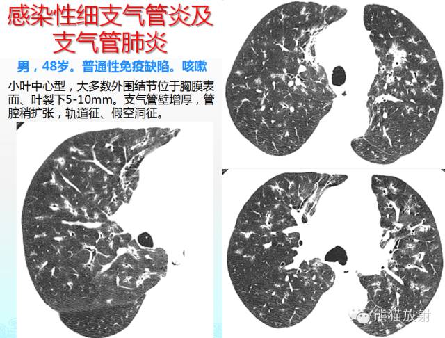 肺粟粒样结节鉴别诊断