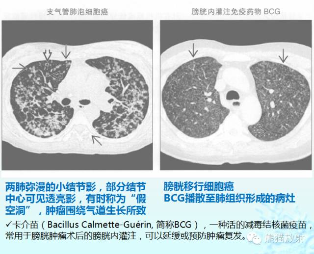 肺粟粒样结节鉴别诊断