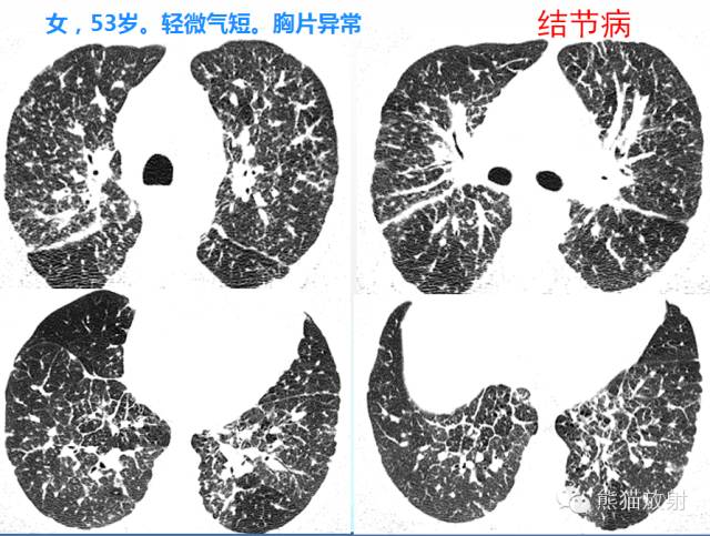 肺粟粒样结节鉴别诊断